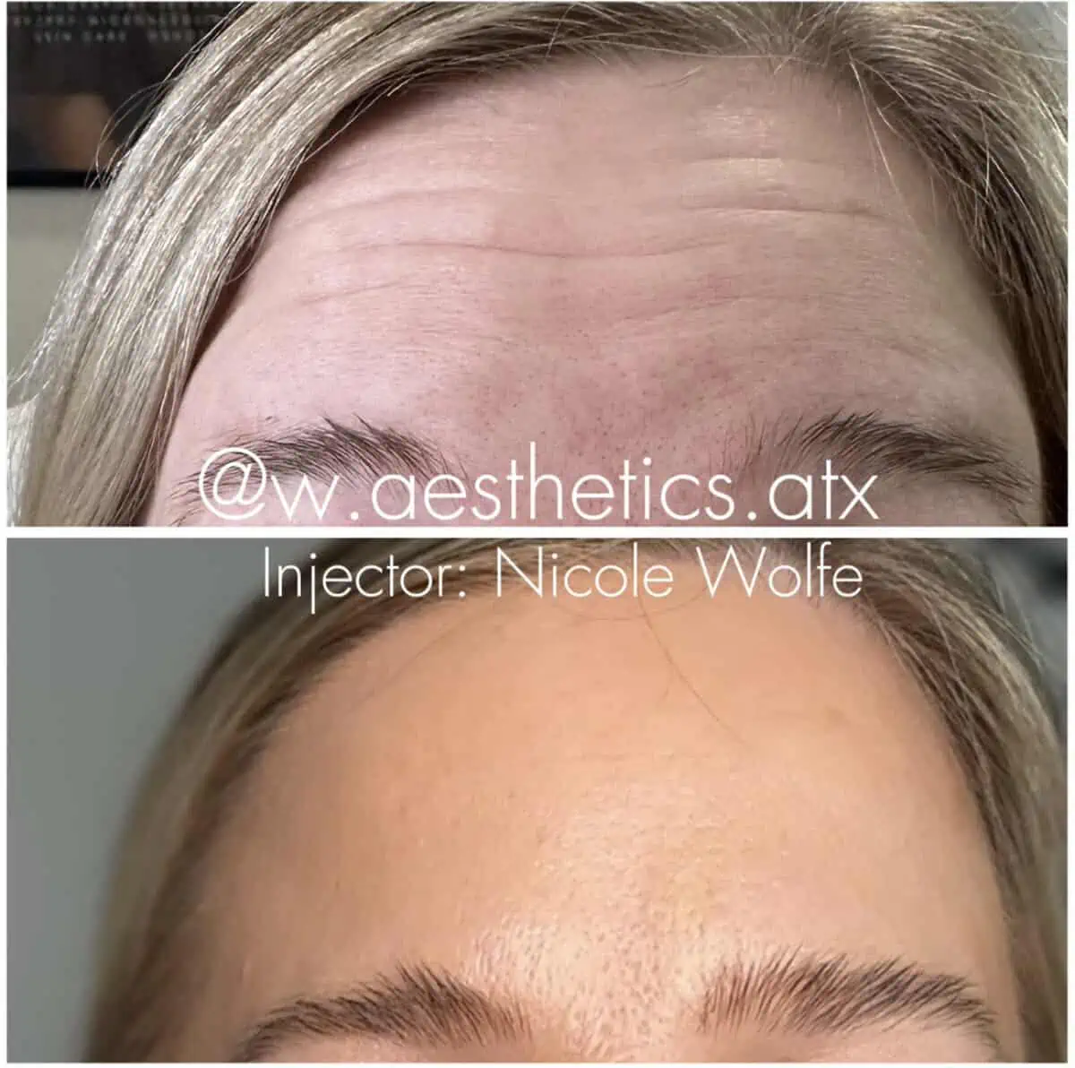 w_aesthetics_botox_before_and_after_austin_texas