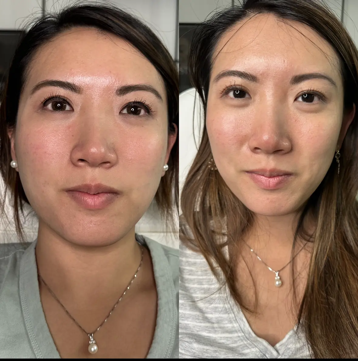 botox_ before_and_after_ W Aesthetics | Austin, TX