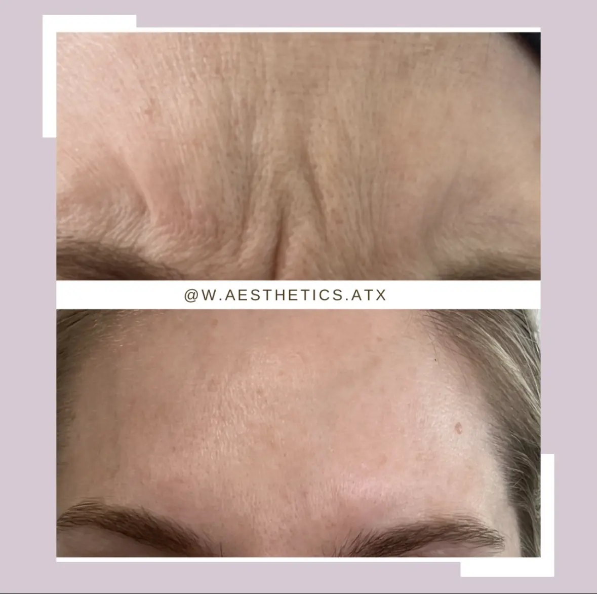 w_aesthetics_botox_before_and_after_austin_texas-of-four