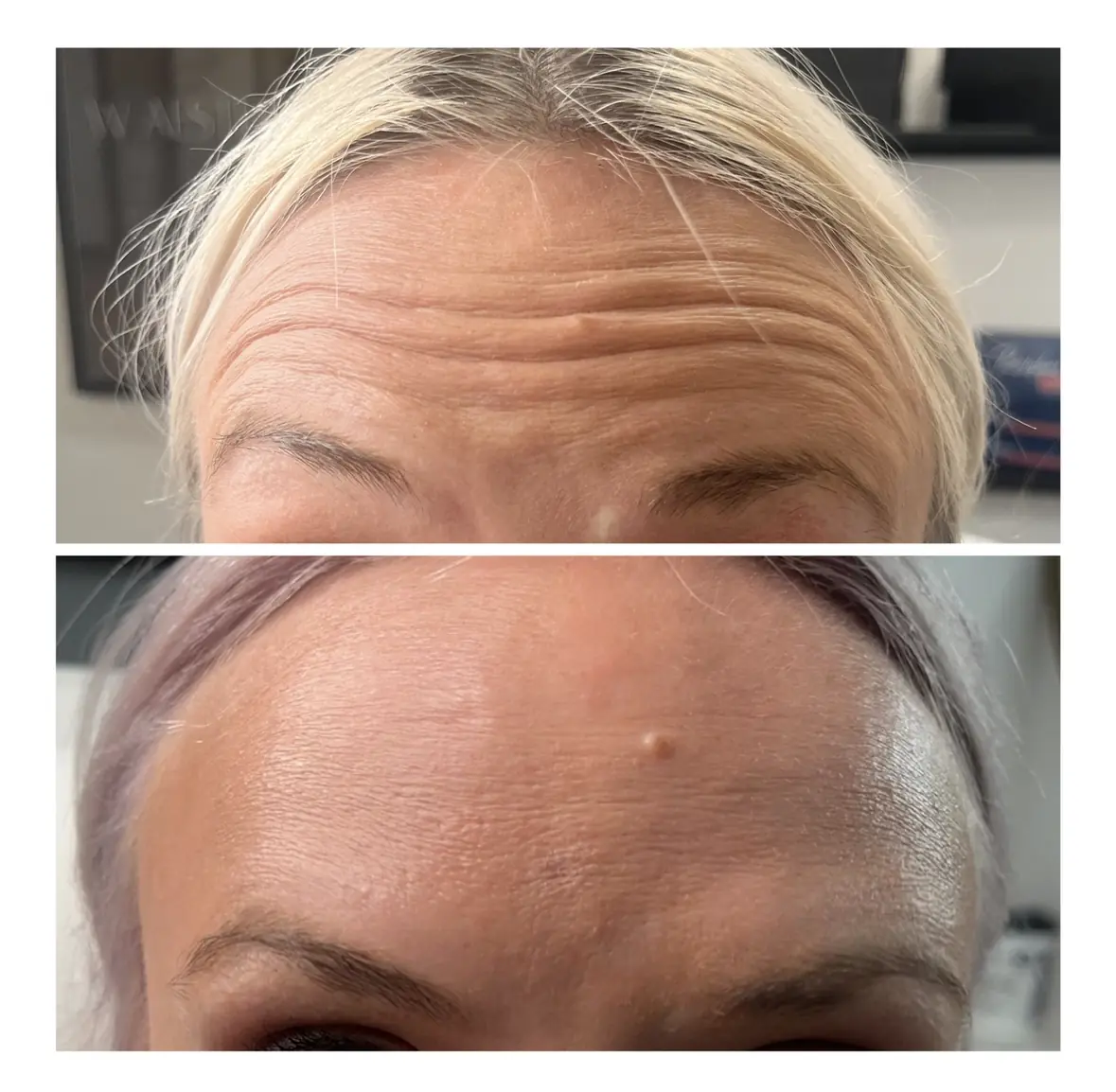 w_aesthetics_botox_before_and_after_austin_texas-of-nine