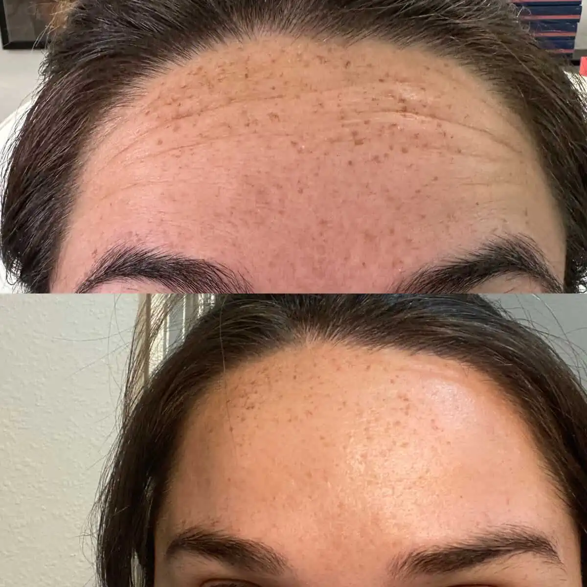 w_aesthetics_botox_before_and_after_austin_texas