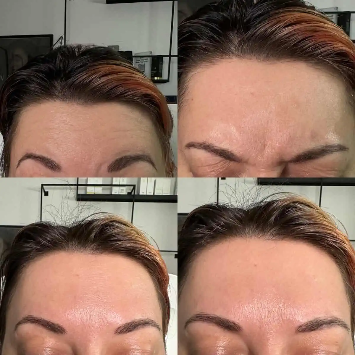 w_aesthetics_botox_before_and_after_austin_texas