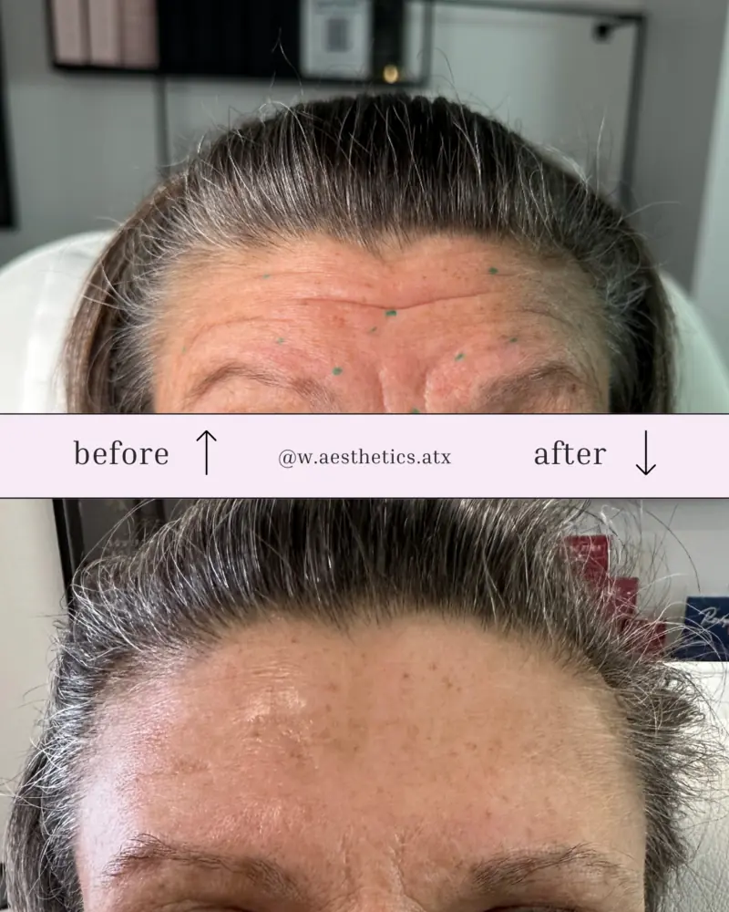 w_aesthetics_botox_before_and_after_austin_texas