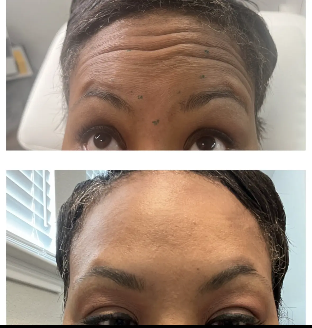 w_aesthetics_botox_before_and_after_austin_texas-of-ten