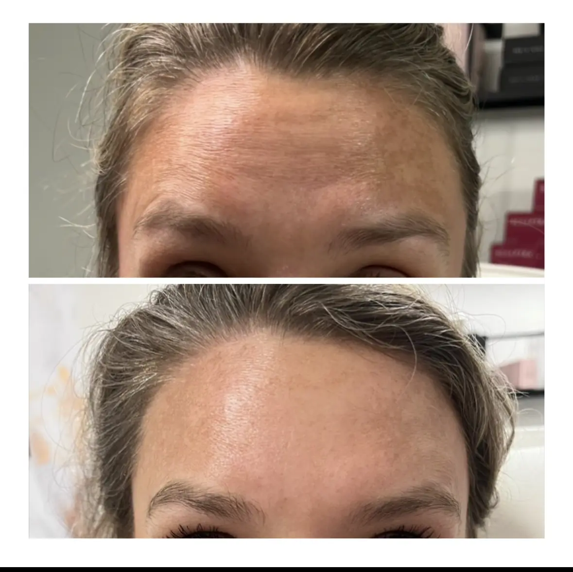 w_aesthetics_botox_before_and_after_austin_texas-of-four