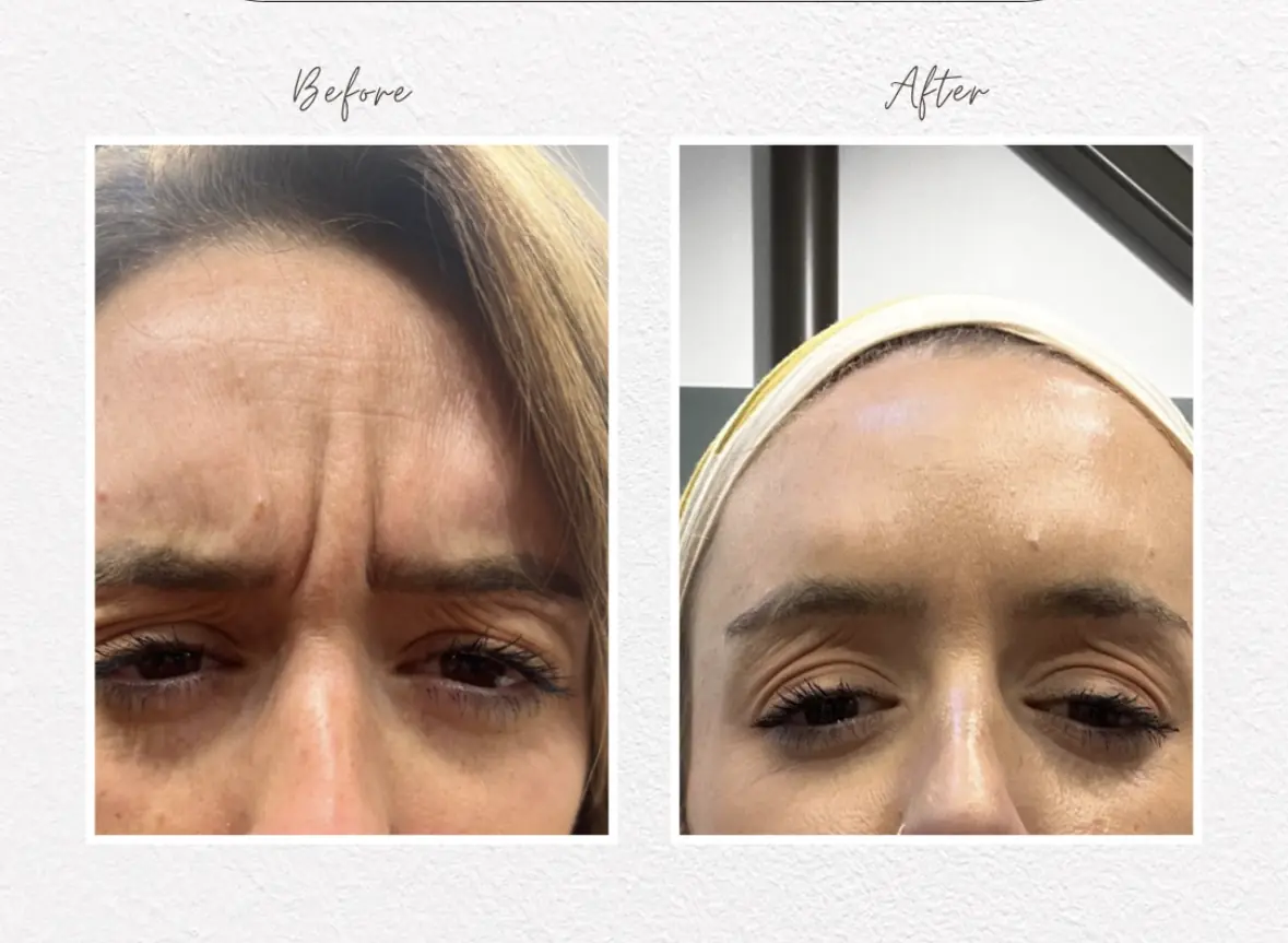 w_aesthetics_botox_before_and_after_austin_texas-of-two