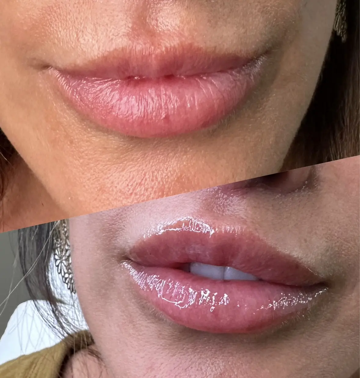 w_aesthetics_lips_before_and_after_austin_texas_seven