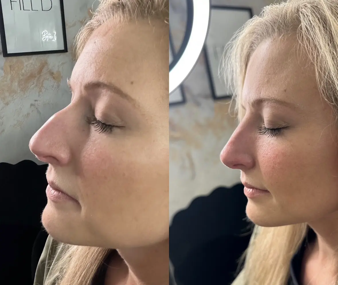 w_aesthetics_nose_job-_before_and_after_austin_texas-six