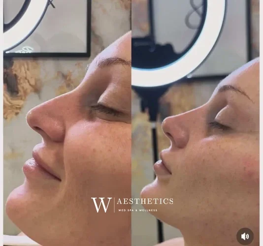 Dermal Fillers - before and after - W Aesthetics in Austin, TX