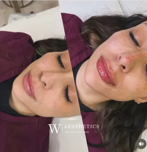 Dermal Fillers - before and after - W Aesthetics in Austin, TX