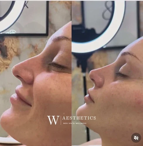 Dermal Fillers - before and after - W Aesthetics in Austin, TX