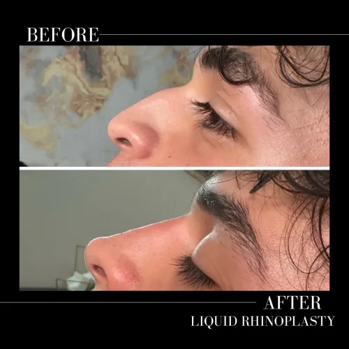 Rhinoplasty-before-and-after (1)