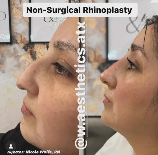 Rhinoplasty-before-and-after (11)