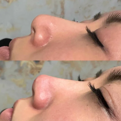 Rhinoplasty-before-and-after (12)