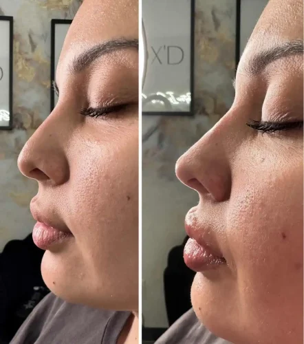 Rhinoplasty-before-and-after (15)