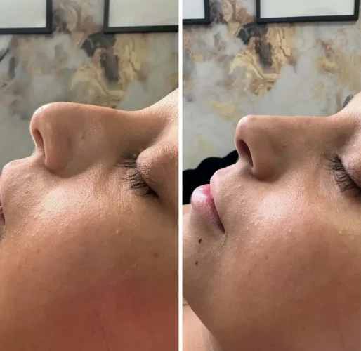 Rhinoplasty-before-and-after (17)