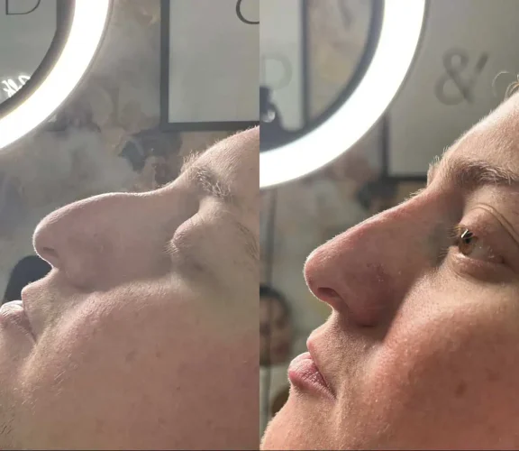 Rhinoplasty-before-and-after (18)