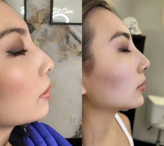 Rhinoplasty-before-and-after (19)