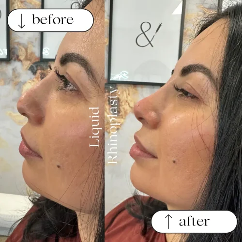 Rhinoplasty-before-and-after (2)