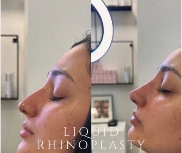 Rhinoplasty-before-and-after (20)