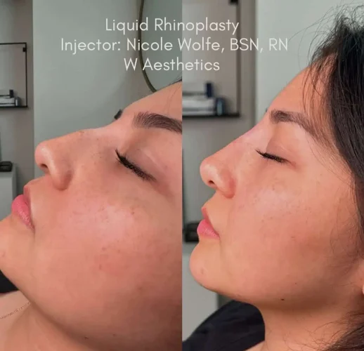 Rhinoplasty-before-and-after (21)