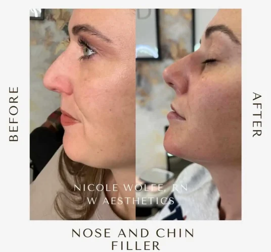 Rhinoplasty-before-and-after (23)