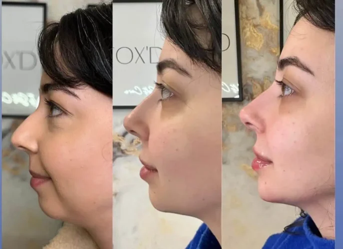 Rhinoplasty-before-and-after (24)