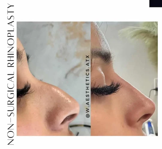 Rhinoplasty-before-and-after (25)