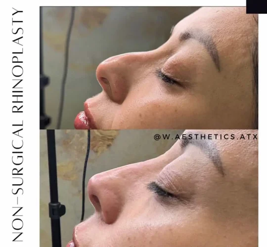 Rhinoplasty-before-and-after (26)