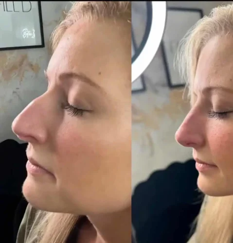 Rhinoplasty-before-and-after (27)