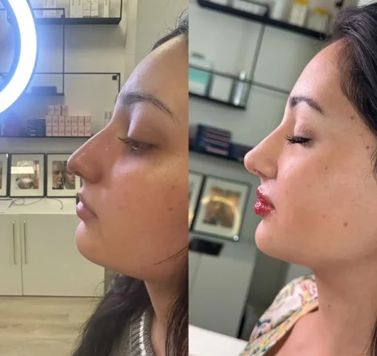 Rhinoplasty-before-and-after (28)