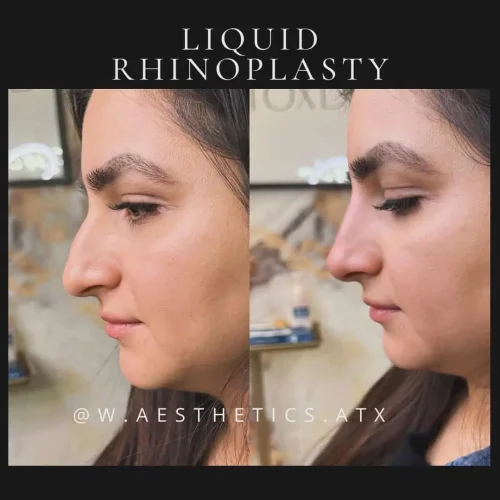 Rhinoplasty-before-and-after (3)