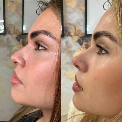 Rhinoplasty-before-and-after (31)