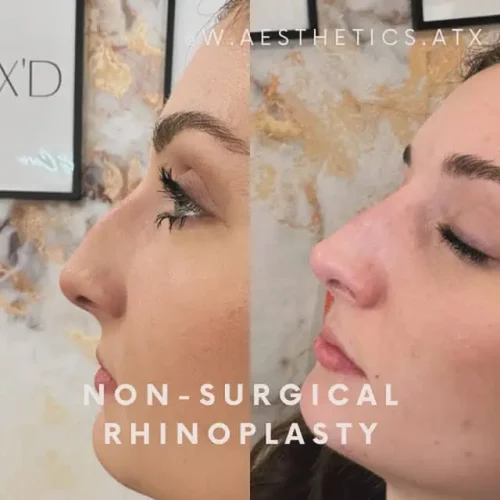 Rhinoplasty-before-and-after (32)