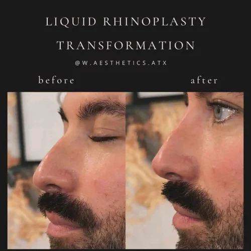 Rhinoplasty-before-and-after (33)