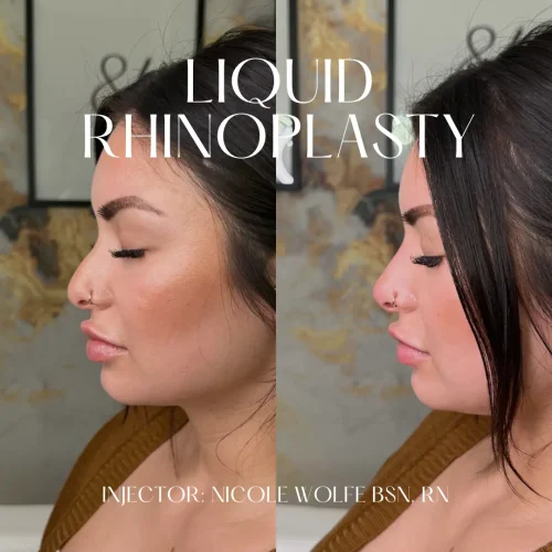 Rhinoplasty-before-and-after (34)