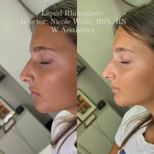 Rhinoplasty-before-and-after (5)