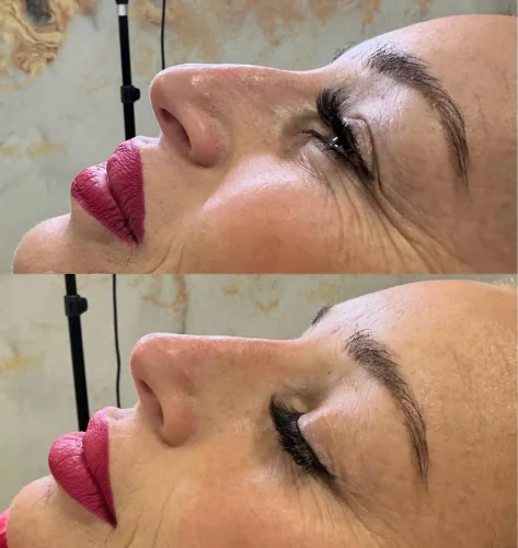 Rhinoplasty-before-and-after (7)