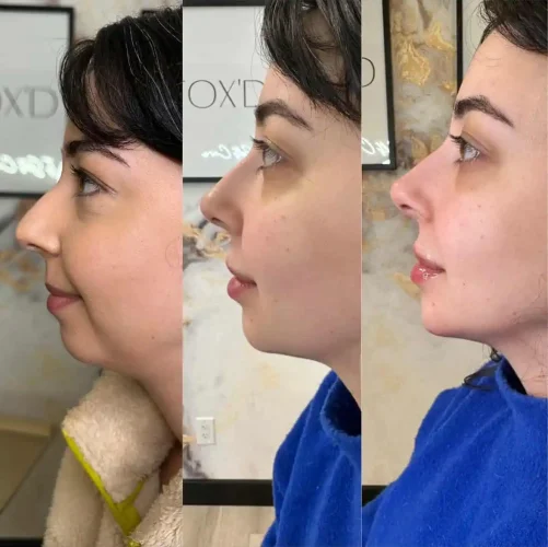 Rhinoplasty-before-and-after (8)