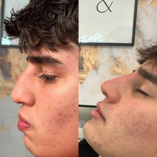 Rhinoplasty-before-and-after (9)