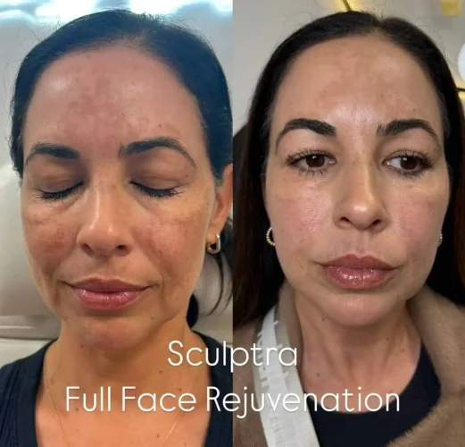 Sculptra Treatment at W Aesthetics in Austin, TX