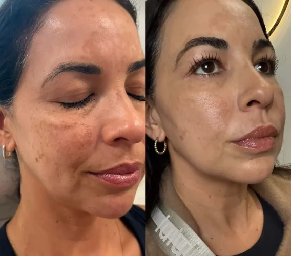 Sculptra Treatment at W Aesthetics in Austin, TX