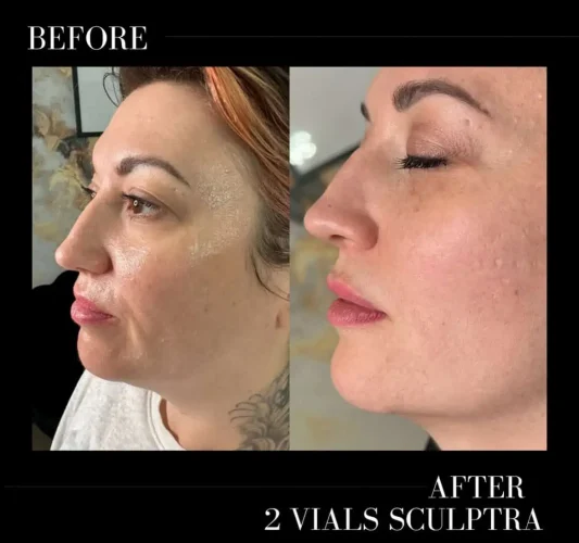 Sculptra Before and After Results at W Aesthetics in Austin, TX