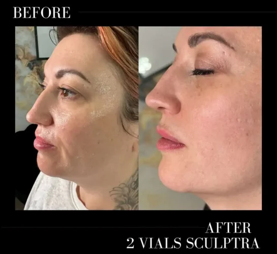 Sculptra Before and After Results at W Aesthetics in Austin, TX