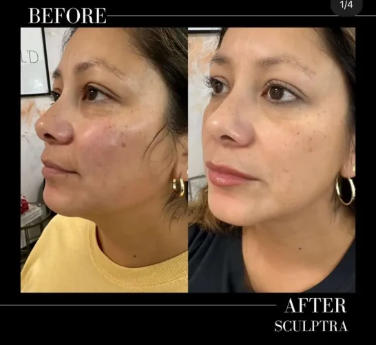 Sculptra Before and After Results at W Aesthetics in Austin, TX