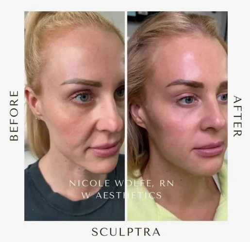 Sculptra-before-and-after-4