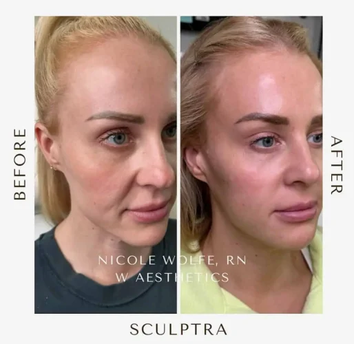 Sculptra Before and After Results at W Aesthetics in Austin, TX