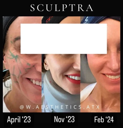 Sculptra Before and After Results at W Aesthetics in Austin, TX