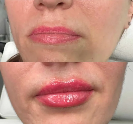 dermal-fillers-before-and-after (12)