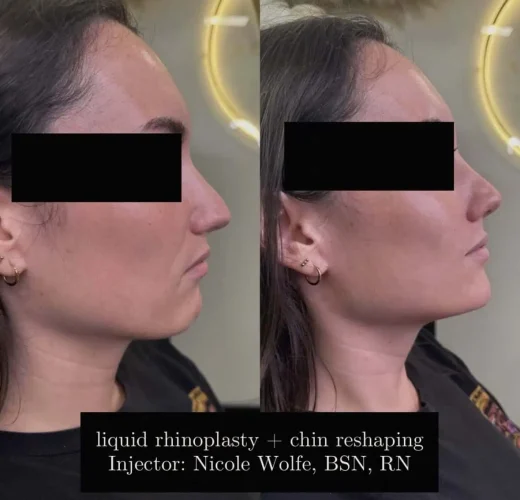 dermal-fillers-before-and-after (13)